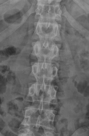 X-Ray