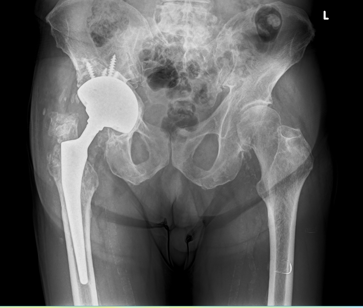 X-Ray